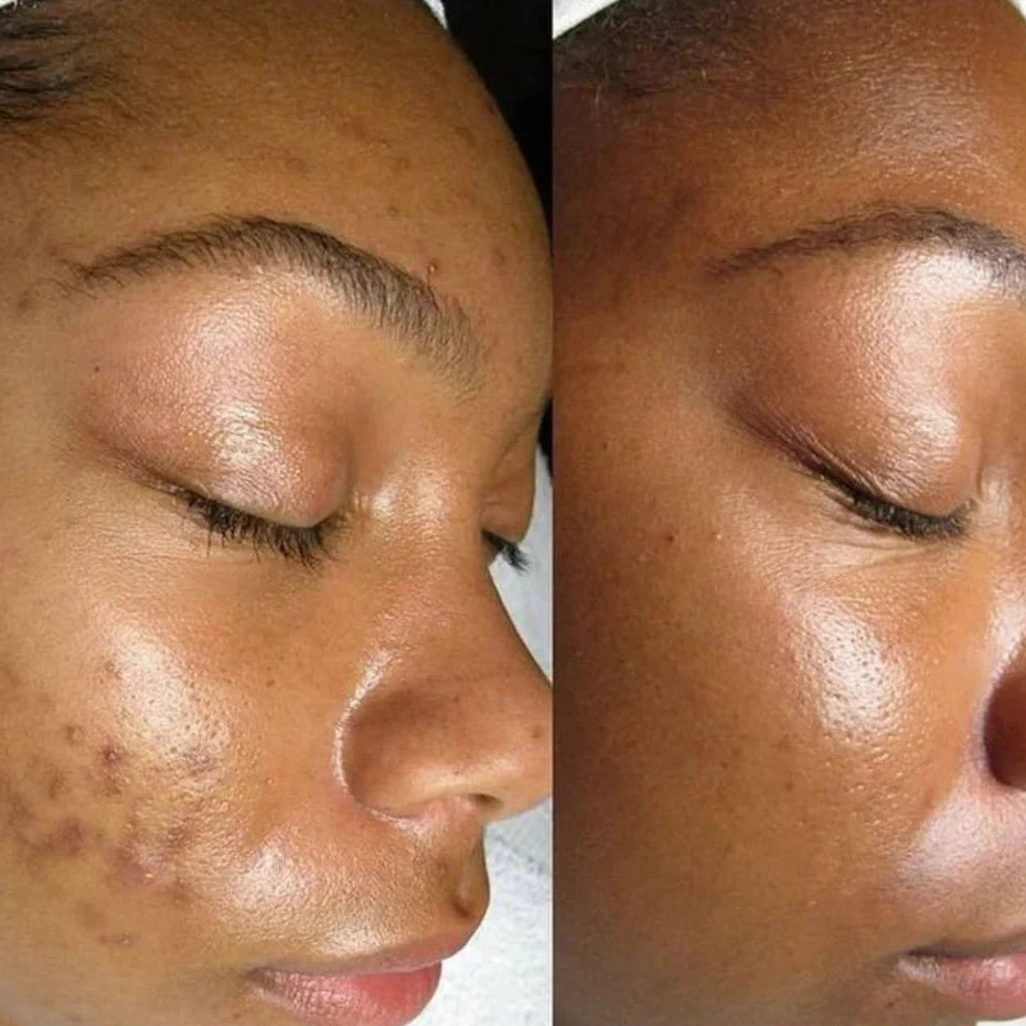 Shiva™ GlowBar Zeep 1+1 Gratis